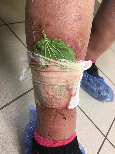 Народные средства от варикоза на ранней стадии Народные средства от варикоза на ранней стадии