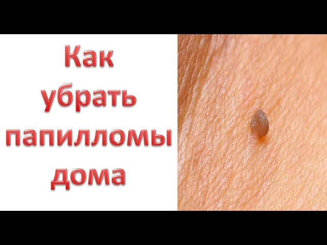 Как избавиться от папиллом на шее в домашних условиях Как избавиться от папиллом на шее в домашних условиях